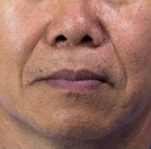 Before/After Image